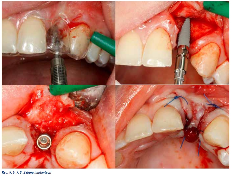 Fot. 3. Leczenie implantoprotetyczne pacjentki