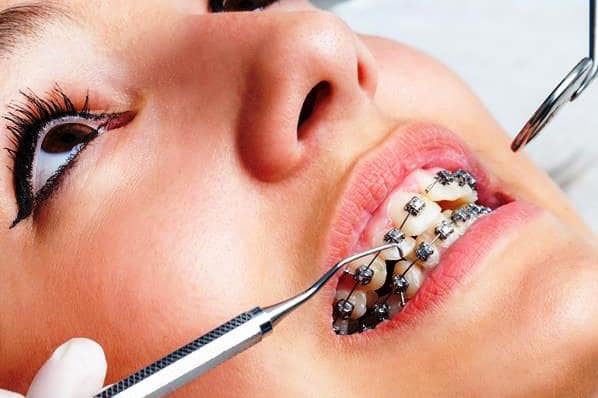 Aparat ortodontyczny – fakty i mity