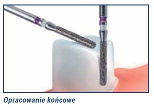 Preparacja zęba pod koronę 2