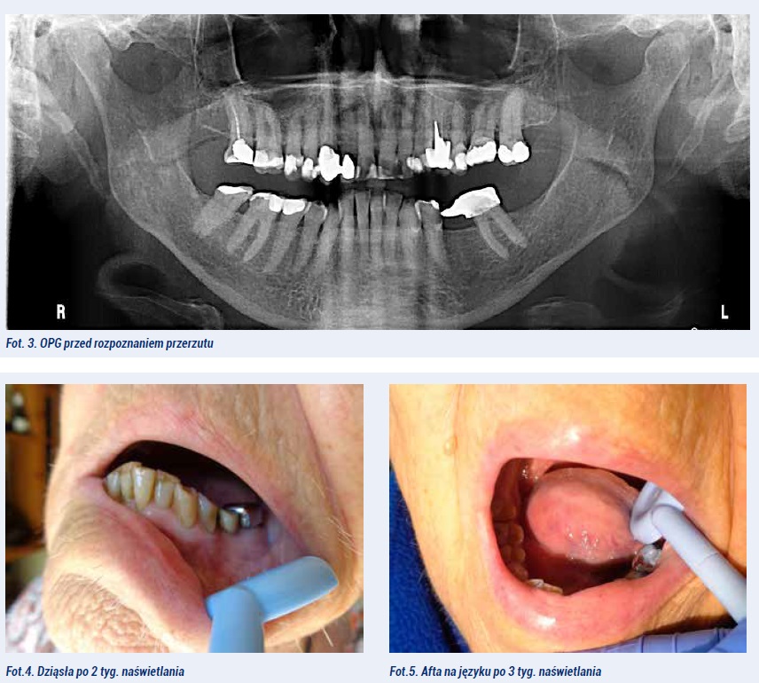 Dental cancer 2