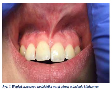 Plastyka wędzidełka Fot1jpg