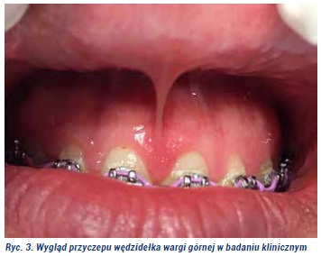 Plastyka wędzidełka Fot3jpg