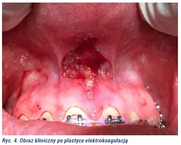 Plastyka wędzidełka Fot4jpg
