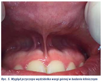 Plastyka wędzidełka Fot5jpg