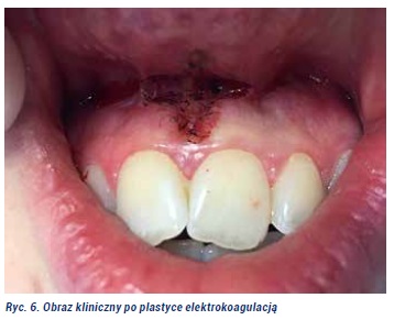 Plastyka wędzidełka Fot6jpg