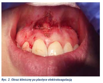 Plastyka wędzidełka Fot2jpg
