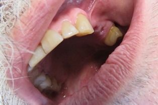 Zabieg implantacji z szablonem