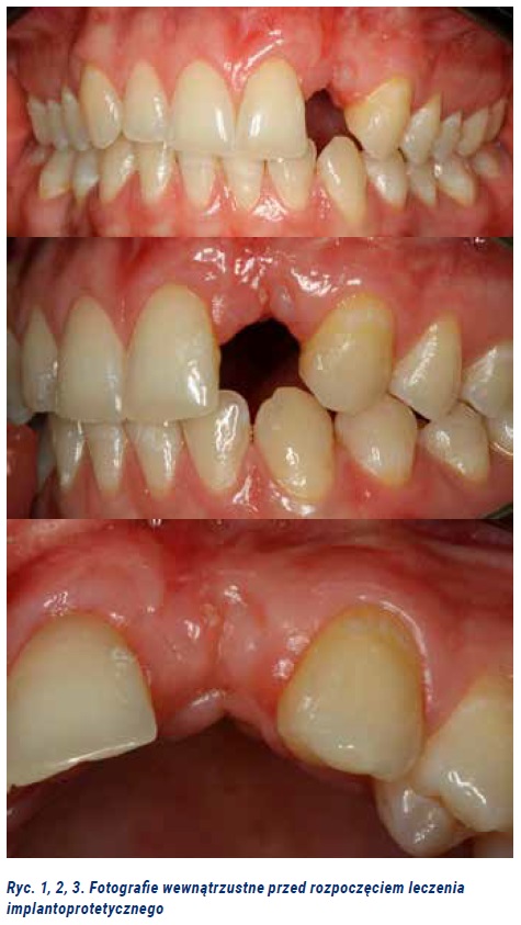 Photo 1. Implant treatment of the patient