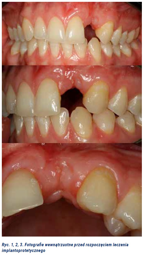 Fot. 1. Leczenie implantoprotetyczne pacjentki