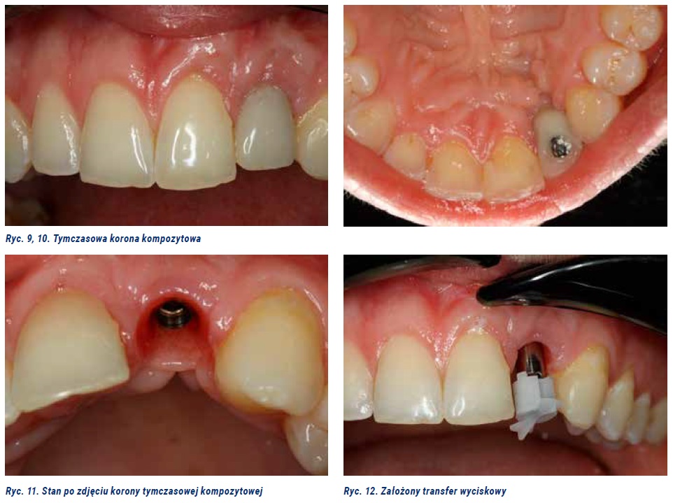 Photo 4. Implant treatment of the patient