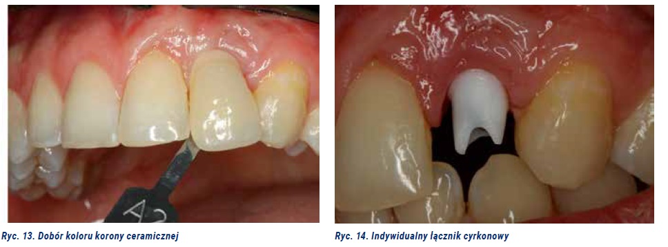 Photo 5. Implant treatment of the patient