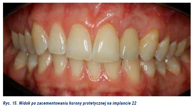 Fot. 6. Leczenie implantoprotetyczne pacjentki