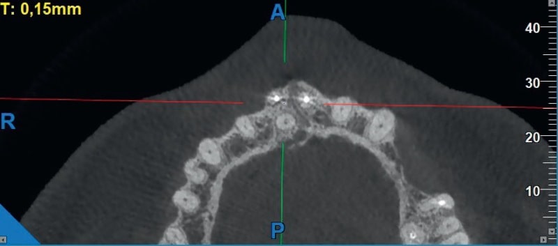 Ryc. 1. Mesjodens zlokalizowany powyżej wierzchołków zębów siecznych