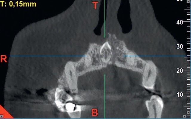 Fig. 2. Perforation of the compact plate of the floor of the nasal cavity