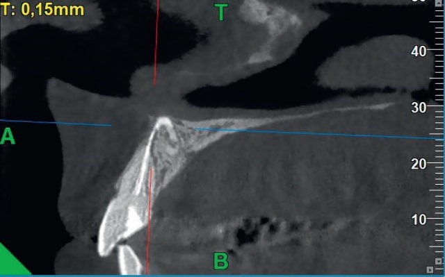 Fig. 3. Damage to the mesiodens dental follicle by a gutta-percha pin