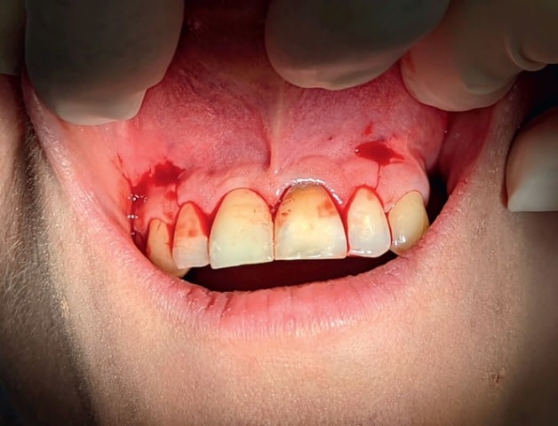 Ryc. 4. Trapezowy płat śluzówkowo okostnowy z cięciem przez brodawki zębowe