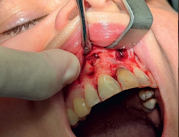 Fig. 5. Access to the supernumerary tooth is shown.