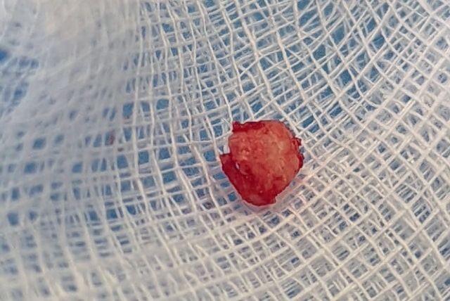 Fig. 6. Removed messiodens