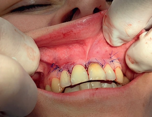 Fig. 8. Suturing the wound with single knotted sutures.