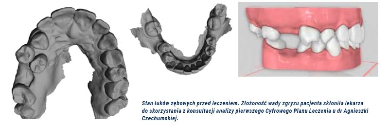 Aligner min