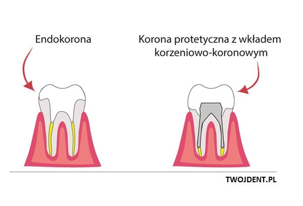 endokorona korona protetyczna big
