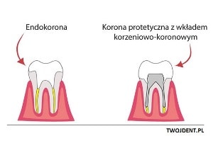 endokorona korona protetyczna min